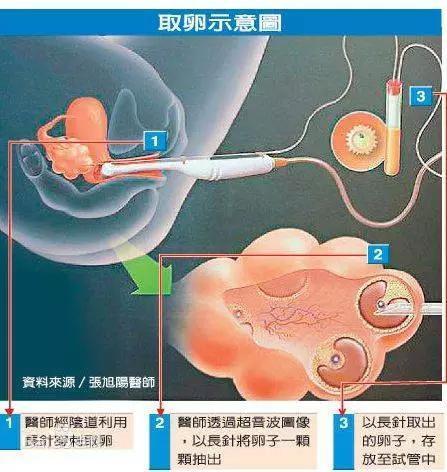 供卵女孩(供卵女孩:生育之路的选择与挑战”)